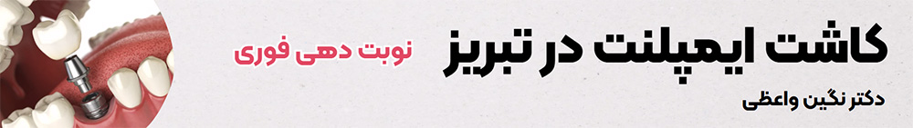 ایمپلنت دندان در تبریز مرکز ایمپلنت دندان در تبریز