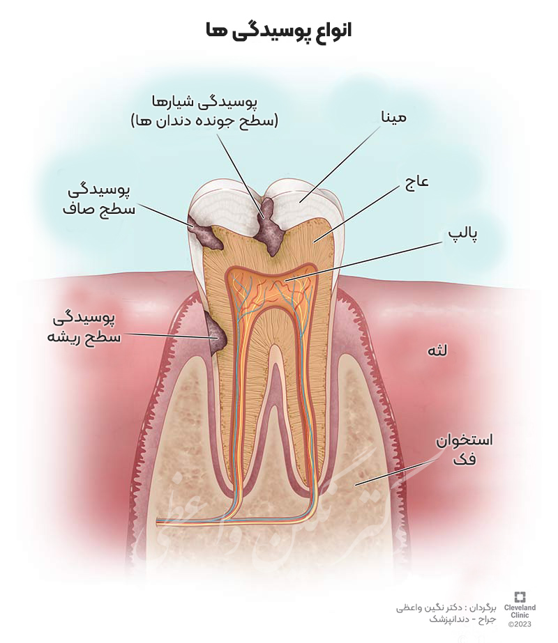 انواع پوسیدگی مدندان   شکل انواع پوسیدگی ها شماتیک cavities