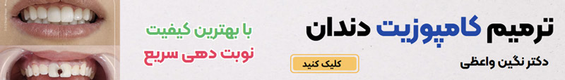 ترمیم کامپوزیت دندان در تبریز