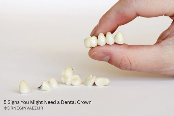 5 نشانه کلیدی و دلیل اصلی که نشان می دهد به روکش دندان نیاز دارید. روکش دندان برای ترک خوردگی، شکستگی و پوسیدگی دندان ضروری است. روکش دندان در تبریز در مطب دکتر نگین واعظی
