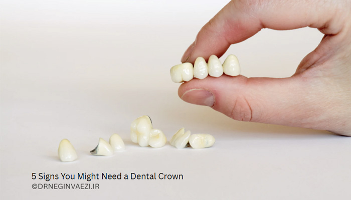 5 نشانه کلیدی و دلیل اصلی که نشان می دهد به روکش دندان نیاز دارید. روکش دندان برای ترک خوردگی، شکستگی و پوسیدگی دندان ضروری است. روکش دندان در تبریز در مطب دکتر نگین واعظی