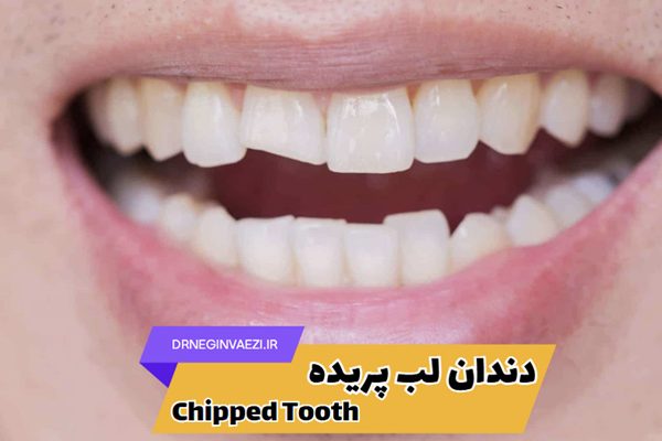 دندان لب پر شده,ترمیم دندان لب پر,هزینه ترمیم دندان لب پر,کامپوزیت دندان لب پر شده در تبریز, ونیر دندان لب پر شده در تبریز ولیعصر