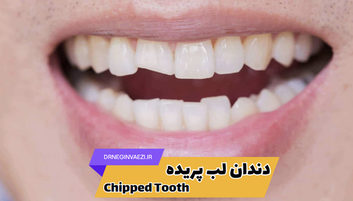 دندان لب پر شده,ترمیم دندان لب پر,هزینه ترمیم دندان لب پر,کامپوزیت دندان لب پر شده در تبریز, ونیر دندان لب پر شده در تبریز ولیعصر