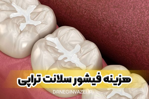 استفاده از فیشور سیلانت برای پیشگیری از پوسیدگی دندان دائمی کودک در مطب دندانپزشکی تبریز - هزینه فیشور سیلانت کودکان در تبریز مرند جلفا