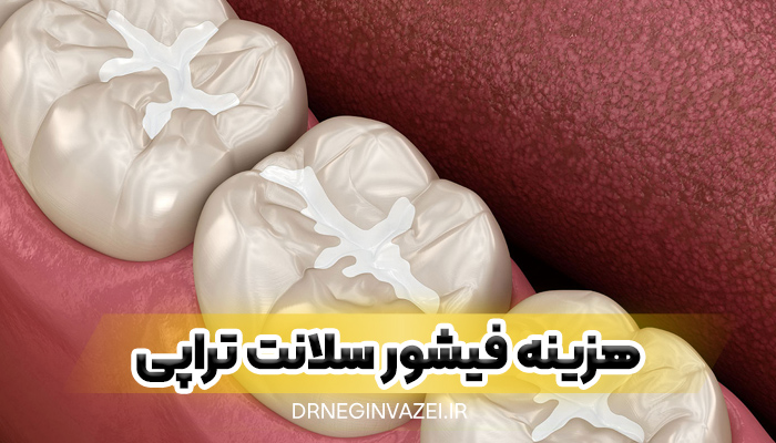 استفاده از فیشور سیلانت برای پیشگیری از پوسیدگی دندان دائمی کودک در مطب دندانپزشکی تبریز - هزینه فیشور سیلانت کودکان در تبریز مرند جلفا