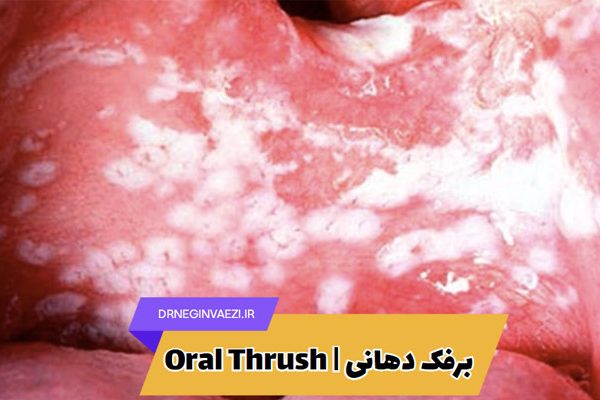 برفک دهانی Oral thrush یا کاندیدیاز چیست؟با علائم، دلایل، روش های سریع درمان و راه های پیشگیری از برفک دهان در کودکان و بزرگسالان آشنا شوید.