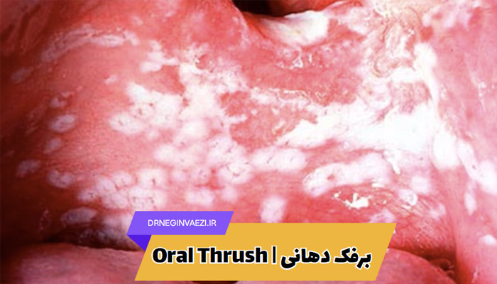 برفک دهانی Oral thrush یا کاندیدیاز چیست؟با علائم، دلایل، روش های سریع درمان و راه های پیشگیری از برفک دهان در کودکان و بزرگسالان آشنا شوید.