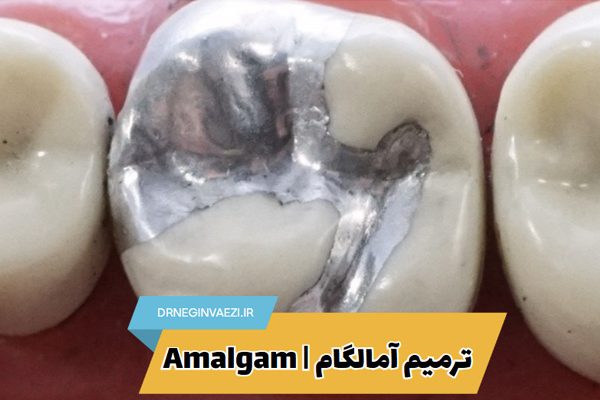 آمالگام دندان ترمیم دندان با آمالگام جیوه در پرکردگی دندان ترمیم آمالگام در تبریز پر کردن دندان با آمالگام دندانپزشک متخصص ترمیم در تبریز