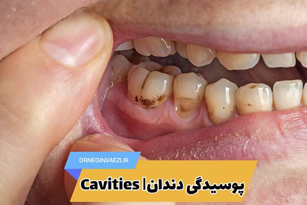 پوسیدگی دندان درمان پوسیدگی دندان علائم پوسیدگی دندان کرم خوردگی دندان حفره دندانی علت پوسیدگی دندان پیشگیری از پوسیدگی دندان