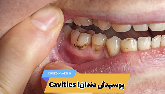 پوسیدگی دندان درمان پوسیدگی دندان علائم پوسیدگی دندان کرم خوردگی دندان حفره دندانی علت پوسیدگی دندان پیشگیری از پوسیدگی دندان