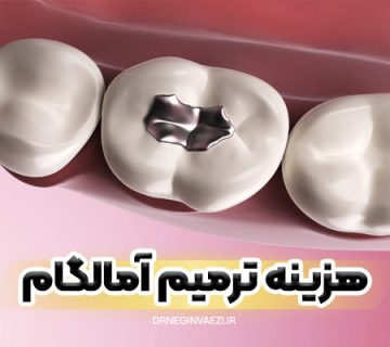 آمالگام دندان در تبریز قیمت ترمیم دندان 1404 ترمیم پوسیدگی دندان با آمالگام قیمت ترمیم آمالگام 1405 پرکردگی آمالگام در تبریز 1406
