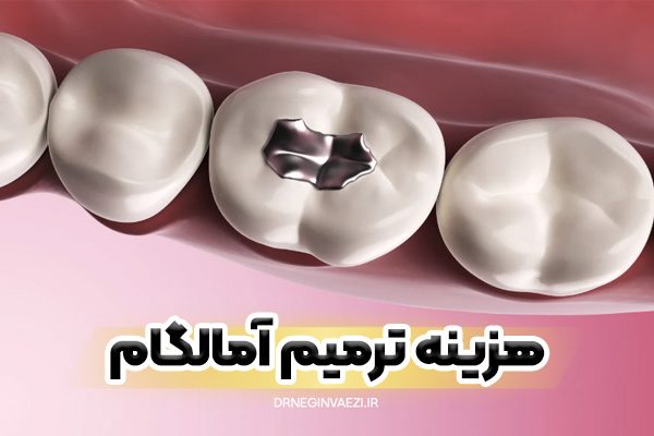آمالگام دندان در تبریز قیمت ترمیم دندان 1404 ترمیم پوسیدگی دندان با آمالگام قیمت ترمیم آمالگام 1405 پرکردگی آمالگام در تبریز 1406