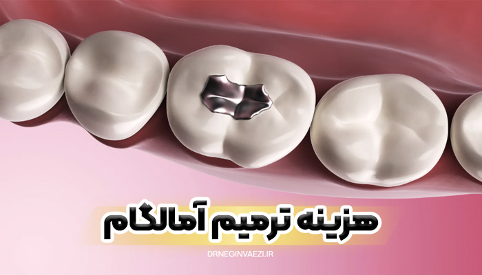 آمالگام دندان در تبریز قیمت ترمیم دندان 1404 ترمیم پوسیدگی دندان با آمالگام قیمت ترمیم آمالگام 1405 پرکردگی آمالگام در تبریز 1406