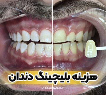 قیمت بلیچینگ دندان در تبری هزینه سفید کردن دندان در تبریز بلیچینگ ارزان در تبریز ولیعصر دکتر نگین واعظی نمونه کار در تبریز