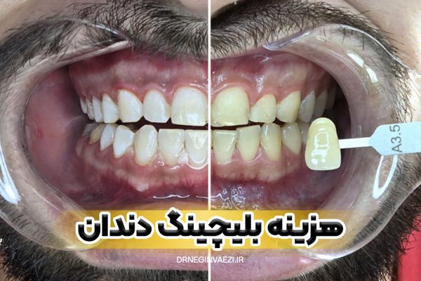 قیمت بلیچینگ دندان در تبری هزینه سفید کردن دندان در تبریز بلیچینگ ارزان در تبریز ولیعصر دکتر نگین واعظی نمونه کار در تبریز