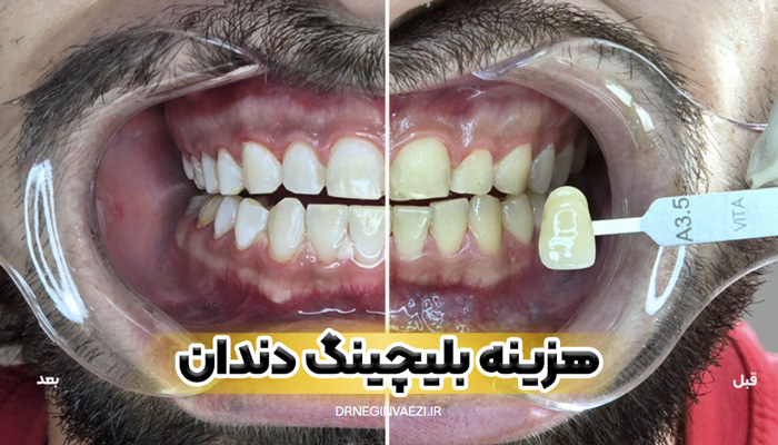 قیمت بلیچینگ دندان در تبری هزینه سفید کردن دندان در تبریز بلیچینگ ارزان در تبریز ولیعصر دکتر نگین واعظی نمونه کار در تبریز