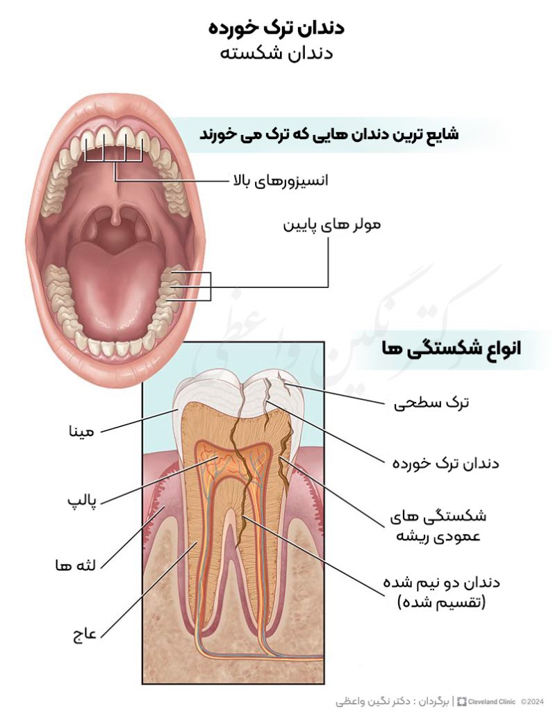 انواع شکستگی های دندان انواع شایع ترک خوردن دندان   درمان شکستگی و ترک خوردگی دندان در تبریز