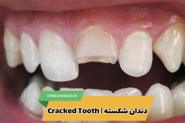دندان ترک خورده یا شکسته دارید؟ در این مقاله با علت، علائم و روش‌های درمان دندان شکسته در تبریز آشنا شوید. جلوگیری از آسیب بیشتر با درمان به‌موقع ممکن است. دندان ترک خورده دندان شکسته دندانپزشک خوب تبریز