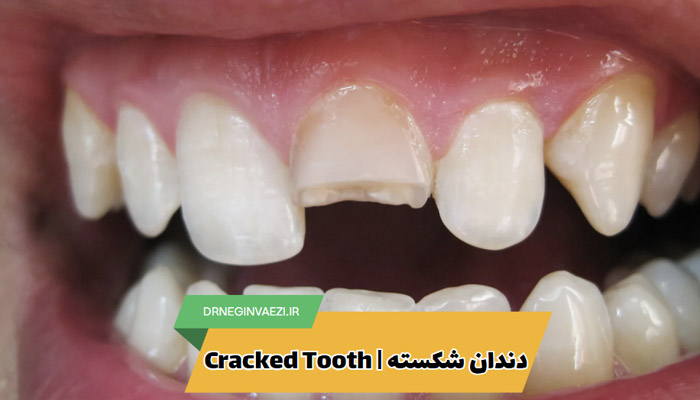 دندان ترک خورده یا شکسته دارید؟ در این مقاله با علت، علائم و روش‌های درمان دندان شکسته در تبریز آشنا شوید. جلوگیری از آسیب بیشتر با درمان به‌موقع ممکن است. دندان ترک خورده دندان شکسته دندانپزشک خوب تبریز