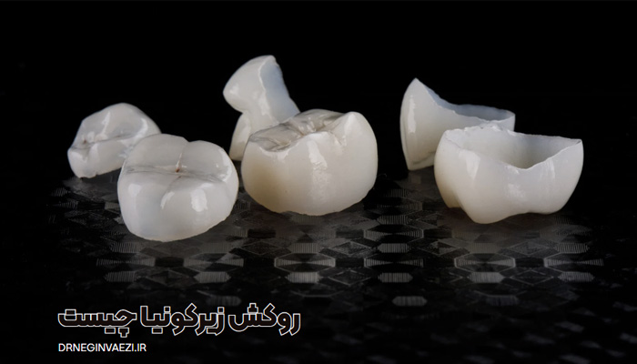 روکش زیرکونیا چیست