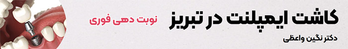 کاشت فوری ایمپلنت در تبریز