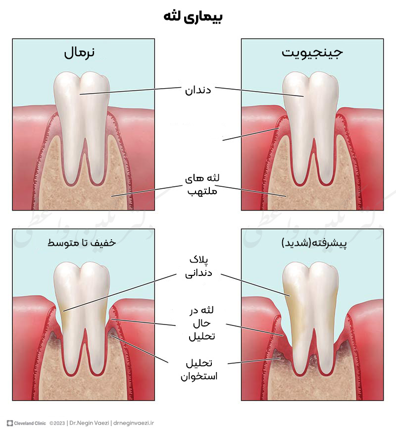 مراحل بیماری لثه پریودنتال