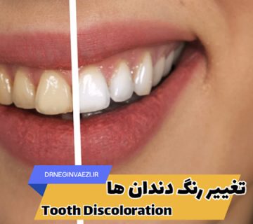 تصویر دندان زرد رنگ و تغییر رنگ ان بعد از درمان زیبایی سفید کننده دندان در تبریز