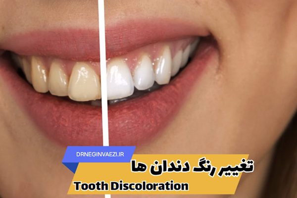 تصویر دندان زرد رنگ و تغییر رنگ ان بعد از درمان زیبایی سفید کننده دندان در تبریز