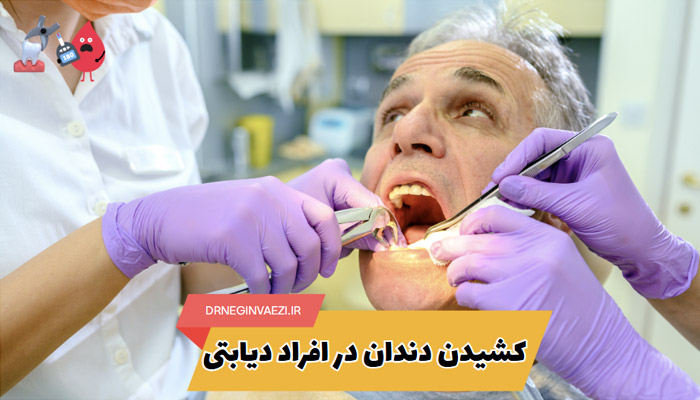 راهنمای کامل کشیدن دندان در بیماران دیابتی: آمادگی، مراقبت ها، کاهش ریسک عفونت و نکات حیاتی برای بهبودی سریعتر | معرفی دندانپزشک در تبریز