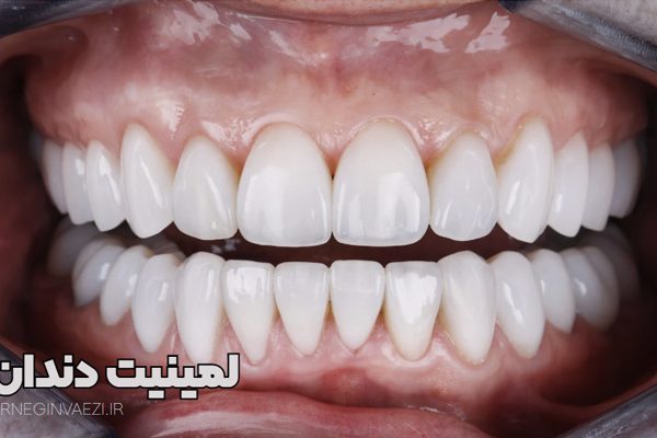 لمینیت سرامیکی - بهترین دکتر لمینیت در تبریز - بهترین دندانپزشک لمینت در تبریز - مرکز انجام لمینت دندان در تبریز - لمینیت ارزان تبریز