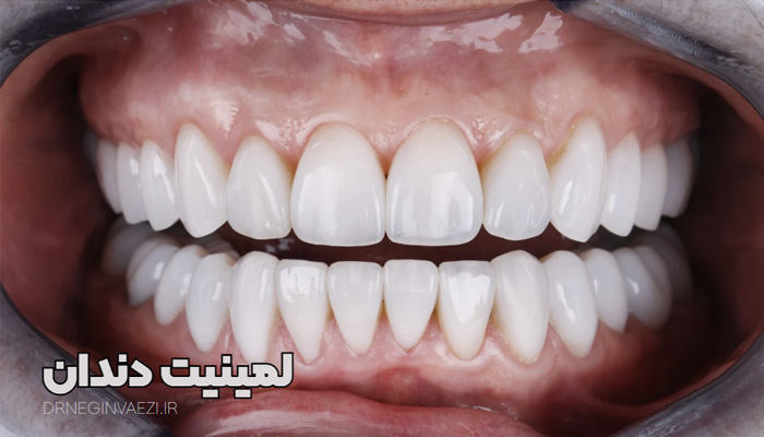 لمینیت سرامیکی - بهترین دکتر لمینیت در تبریز - بهترین دندانپزشک لمینت در تبریز - مرکز انجام لمینت دندان در تبریز - لمینیت ارزان تبریز