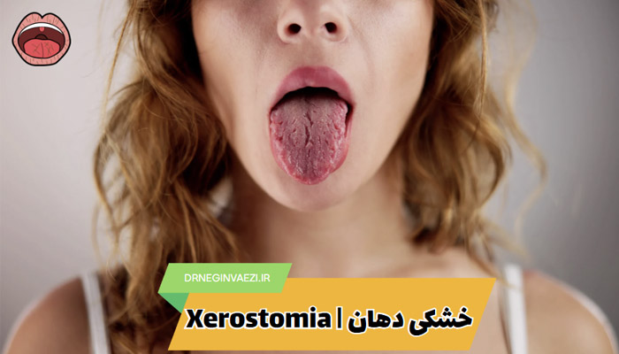 زروستومیا,بیماری های دهان و دندان,درمان خشکی دهان,علایم خشکی دهان,Xerostomia