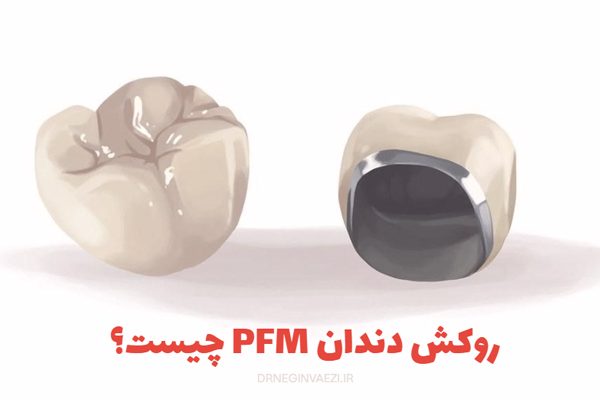روکش پی اف ام چیست؟روکش pfm در تبریز,بهترین روکش پی اف ام تبریز,طول عمر روکش پی اف ام,معایب روکش پی اف ام ,قیمت روکش پی اف ام,مراحل ساخت روکش پی اف ام