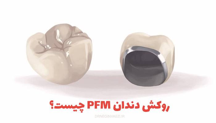 روکش پی اف ام چیست؟روکش pfm در تبریز,بهترین روکش پی اف ام تبریز,طول عمر روکش پی اف ام,معایب روکش پی اف ام ,قیمت روکش پی اف ام,مراحل ساخت روکش پی اف ام
