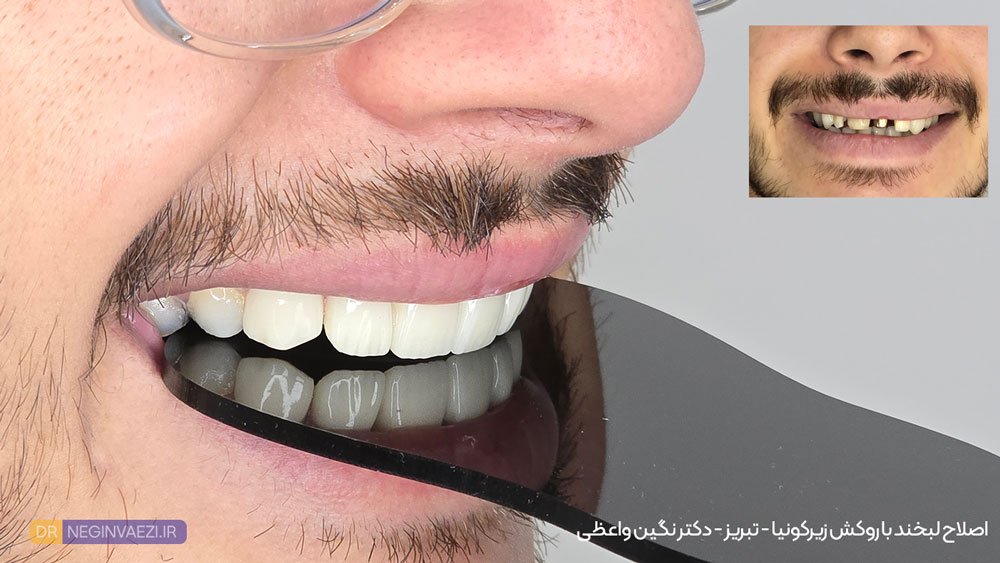 روکش سرامیکی زیرکونیا در تبریز و اصلاح طرح لبخند توسط دکتر نگین واعظی ولیعصر تبریز - عکس قبل و بعد نمونه کار