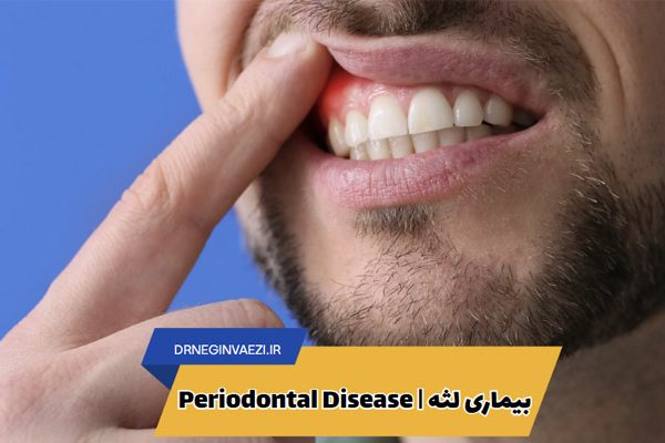 بیماری لثه التهاب لثه عفونت لثه درمان بیماری لثه پیشگیری از بیماری لثه علائم بیماری لثه periodontitis periodontal disease gum disease