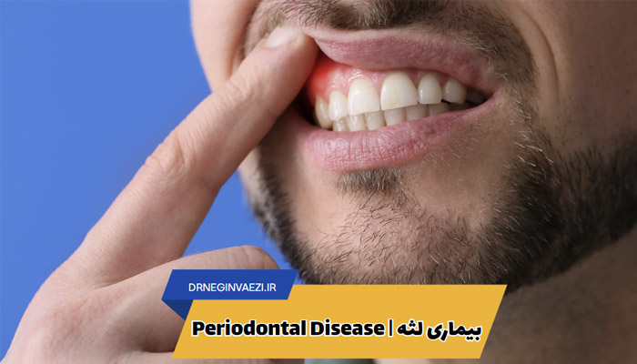 بیماری لثه التهاب لثه عفونت لثه درمان بیماری لثه پیشگیری از بیماری لثه علائم بیماری لثه periodontitis periodontal disease gum disease
