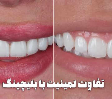 تفاوت لمینت دندان با بلیچینگ دندان ، مزایا و معایب ، مقایسه هزینه و قیمت ها و شرایط استفاده - حذف شرط: تفاوت بلیچینگ با لمینت تفاوت بلیچینگ با لمینتحذف شرط: لمینت دندان در تبریز لمینت دندان در تبریزحذف شرط: بلیچینگ دندان در تبریز بلیچینگ دندان در تبریزحذف شرط: فرق لمینت با بلیچینگ فرق لمینت با بلیچینگ