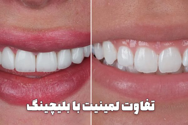 تفاوت لمینت دندان با بلیچینگ دندان ، مزایا و معایب ، مقایسه هزینه و قیمت ها و شرایط استفاده - حذف شرط: تفاوت بلیچینگ با لمینت تفاوت بلیچینگ با لمینتحذف شرط: لمینت دندان در تبریز لمینت دندان در تبریزحذف شرط: بلیچینگ دندان در تبریز بلیچینگ دندان در تبریزحذف شرط: فرق لمینت با بلیچینگ فرق لمینت با بلیچینگ