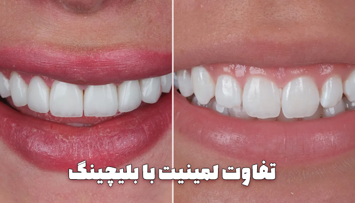 تفاوت لمینت دندان با بلیچینگ دندان ، مزایا و معایب ، مقایسه هزینه و قیمت ها و شرایط استفاده - حذف شرط: تفاوت بلیچینگ با لمینت تفاوت بلیچینگ با لمینتحذف شرط: لمینت دندان در تبریز لمینت دندان در تبریزحذف شرط: بلیچینگ دندان در تبریز بلیچینگ دندان در تبریزحذف شرط: فرق لمینت با بلیچینگ فرق لمینت با بلیچینگ