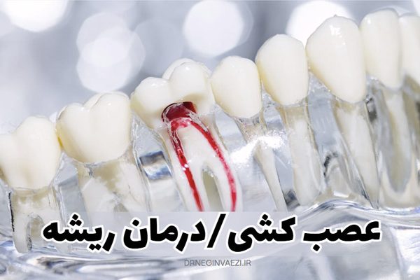درمان ریشه و عصب کشی چیست ,درمان ریشه در تبریز, عصب کشی در تبریز,آیا عصب کشی درد دارد؟ مراحل درمان عصب کشی,عصب کشی در بارداری