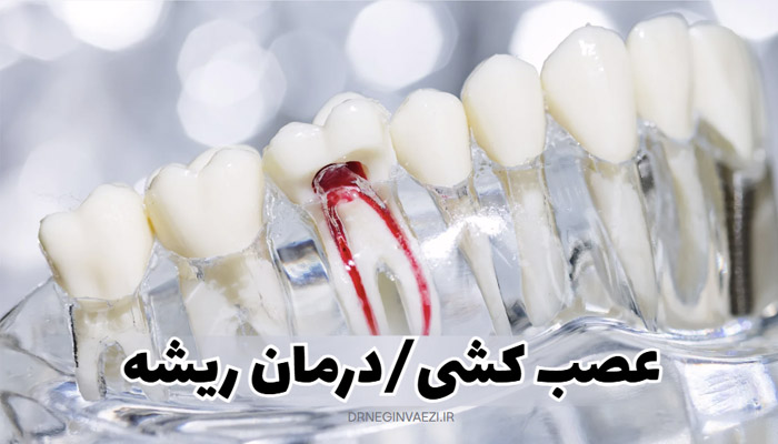 درمان ریشه و عصب کشی چیست ,درمان ریشه در تبریز, عصب کشی در تبریز,آیا عصب کشی درد دارد؟ مراحل درمان عصب کشی,عصب کشی در بارداری