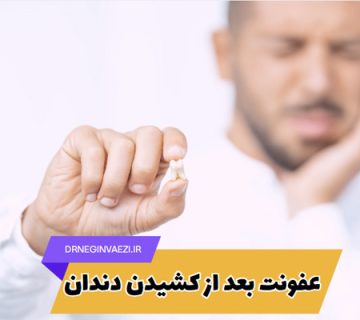 علائم و درمان عفونت بعد از کشیدن دندان در بزرگسالان و کودکان - کشیدن دندان در تبریز
