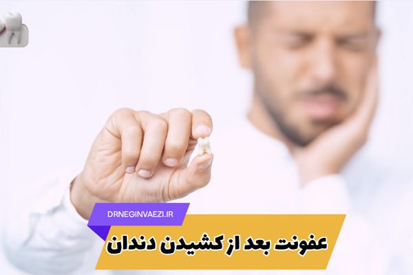 علائم و درمان عفونت بعد از کشیدن دندان در بزرگسالان و کودکان - کشیدن دندان در تبریز
