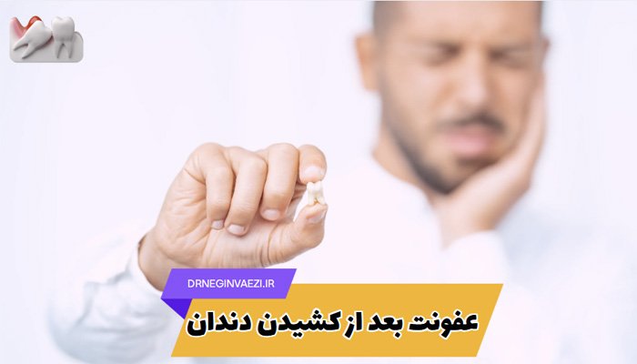 علائم و درمان عفونت بعد از کشیدن دندان در بزرگسالان و کودکان - کشیدن دندان در تبریز
