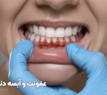 درمان آبسه و عفونت ، درمان خانگی آبسه دندان درمان عفونت دندان عصب کشی دنداندرمان آسه دندان در تبریز درمان عفونت دندان در تبریز نوبت دهی سریع عصب کشی در تبریز