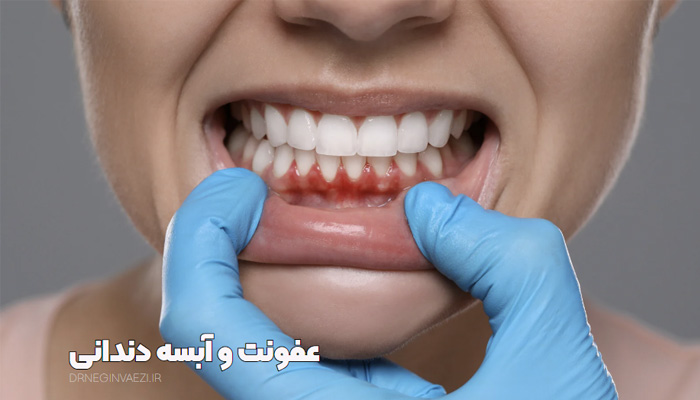 درمان آبسه و عفونت ، درمان خانگی آبسه دندان درمان عفونت دندان عصب کشی دنداندرمان آسه دندان در تبریز درمان عفونت دندان در تبریز نوبت دهی سریع عصب کشی در تبریز