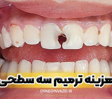 هزینه ترمیم سه سطحی دندان در تبریز سال چقدر است؟ تعرفه دقیق، عوامل موثر روی قیمت و معرفی بهترین دندانپزشک ترمیمی در تبریز