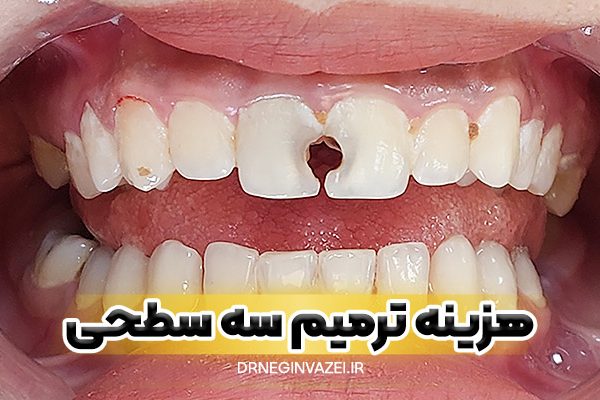 هزینه ترمیم سه سطحی دندان در تبریز سال چقدر است؟ تعرفه دقیق، عوامل موثر روی قیمت و معرفی بهترین دندانپزشک ترمیمی در تبریز