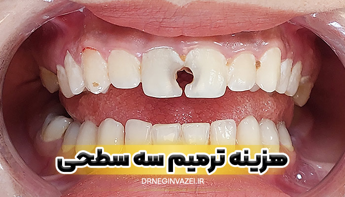 هزینه ترمیم سه سطحی دندان در تبریز سال چقدر است؟ تعرفه دقیق، عوامل موثر روی قیمت و معرفی بهترین دندانپزشک ترمیمی در تبریز